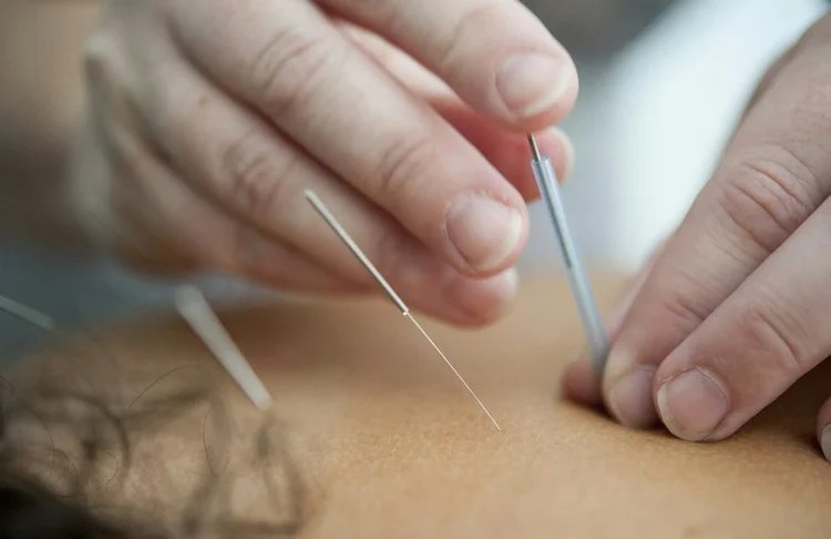 Acupuncture needles placed along a client's back